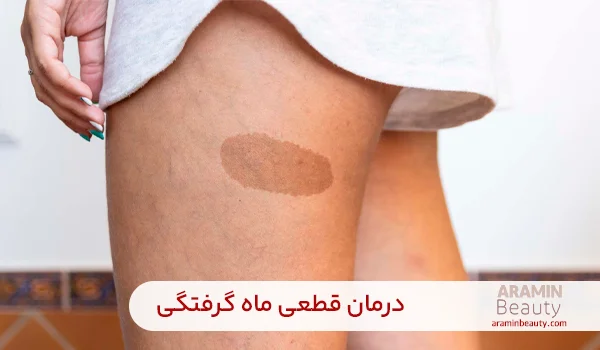 درمان قطعی ماه گرفتگی 