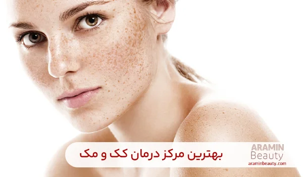 بهترین درمان کک و مک 