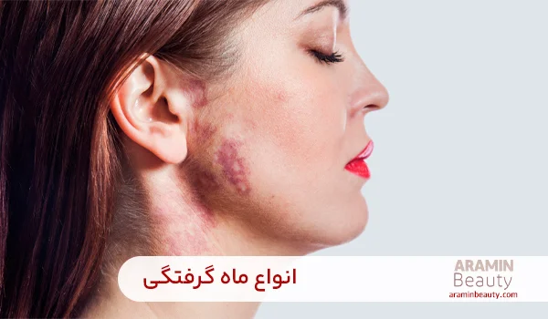 انواع ماه گرفتگی 