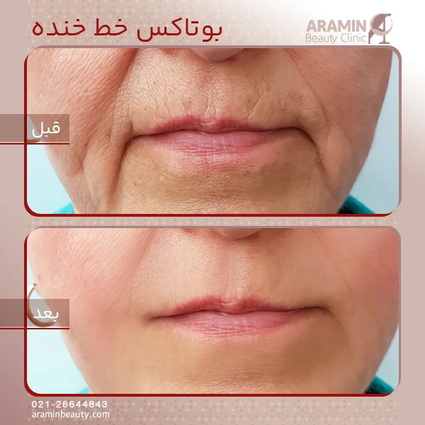 بوتاکس خط خنده 