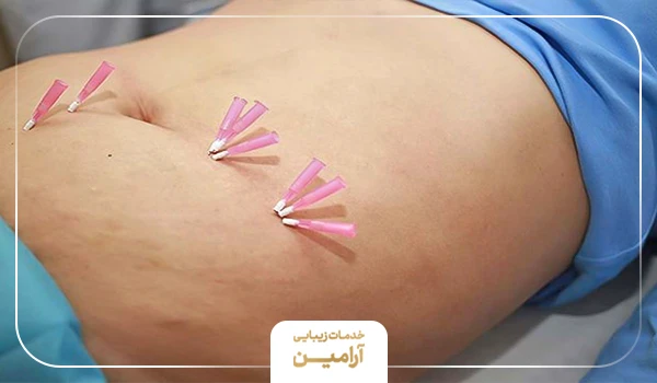 کاشت نخ یا امبدینگ که به عنوان یکی از بهترین روش های لاغری شناخته میشود