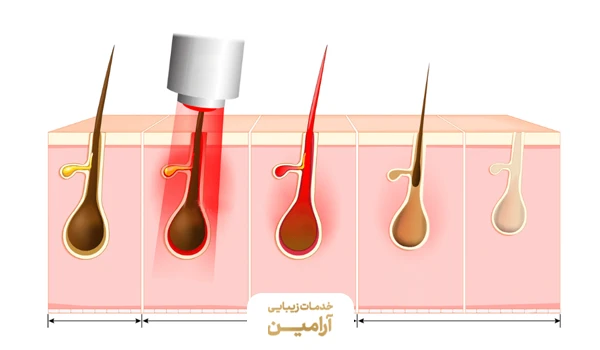 نحوه اثرگذاری چرخه رشد مو بر تعداد جلسات لیزر موهای زائد