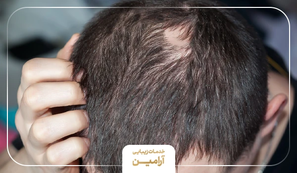 ریزش سمه ای موی سر یک آقا