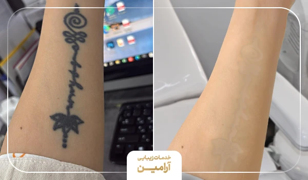 قبل و بعد پاک کردن تاتو دست