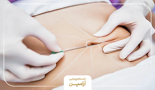 پروسه انجام امبدینگ لاغری