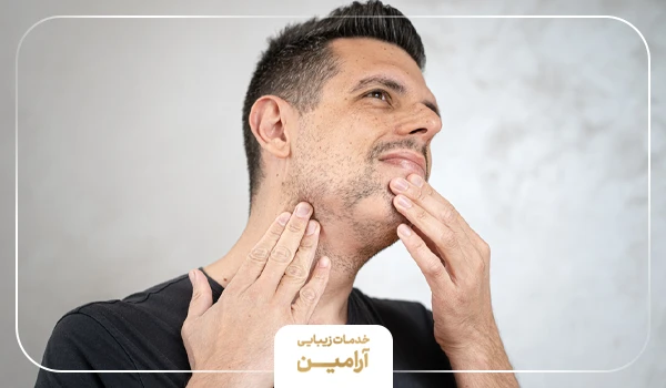 فردی که به فکر درمان ریزش سکه ای ریش خود است