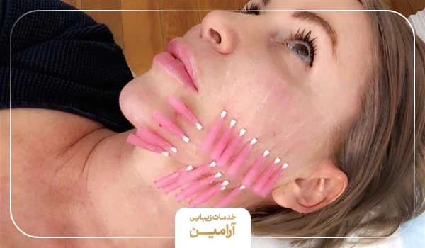 هزینه هر جلسه امبدینگ به عواملی همچون مهارت پزشک، محل کلینیک و کیفیت نخ بستگی دارد