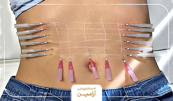 نحوه انجاک امبدینگ یا کاشت نخ لاغری