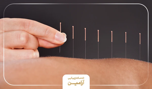 لاغری با طب سوزنی