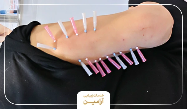 نحوه انجام امبدینگ بازو