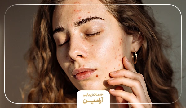 آکنه شدید، یکی از موارد منع هایفوتراپی