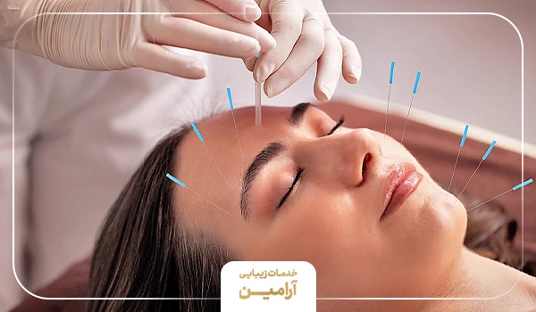 پروسه انجام طب سوزنی صورت