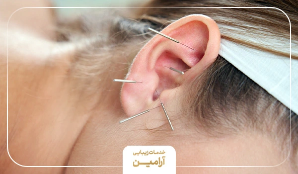 فرایند انجام طب سوزنی گوش برای لاغری