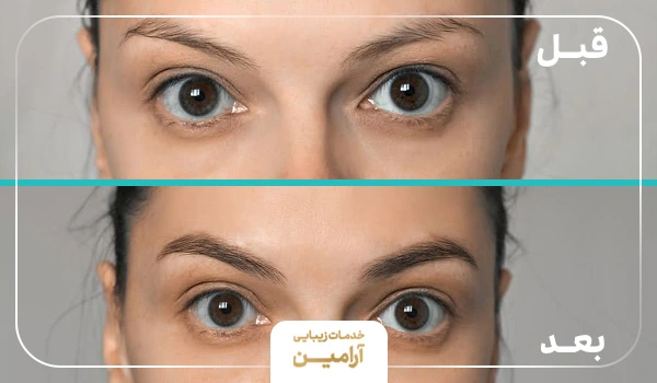 قبل و بعد مزوتراپی ابرو