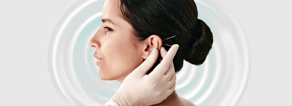 طب سوزنی گوش برای لاغری؛ هرآنچه که باید بدانید
