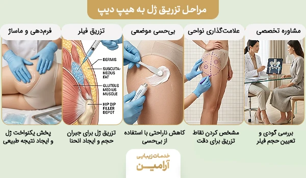 نحوه تزریق فیلر هیپ دیپ