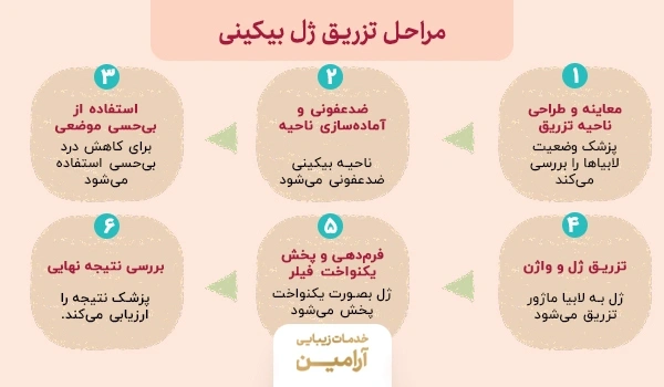 مراحل تزریق فیلر بیکینی